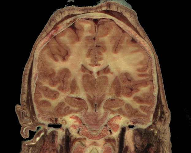 Human coronal